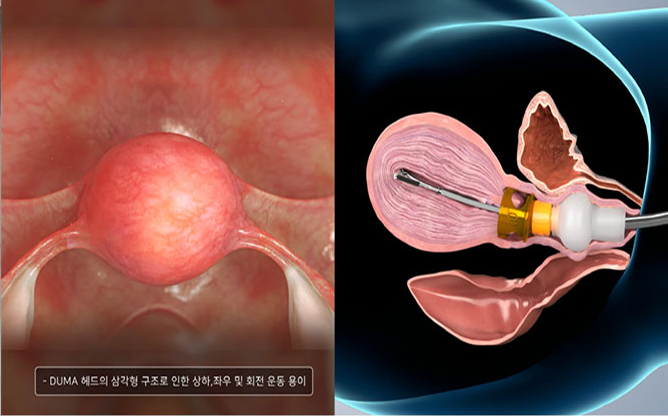 (주)오렌지메딕스 - 자궁거상기