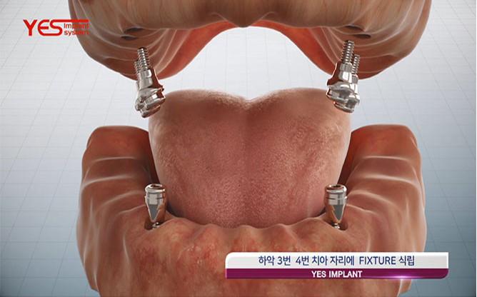 (주)예스바이오테크 - 임플란트 등 치과용 기기 전문