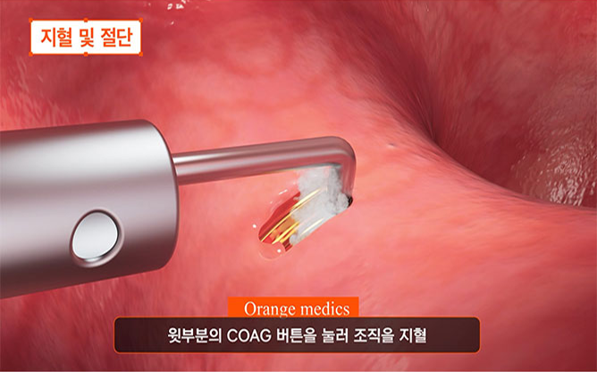 (주)오렌지메딕스 - 압력조절전기흡인세척기