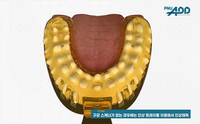 (주)피엔유에드 - 미니 임플란트 시스템