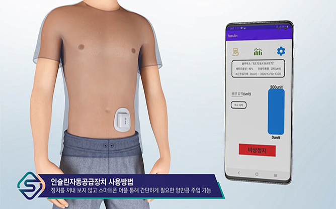 스팁 - 자동 인슐린 주입장치