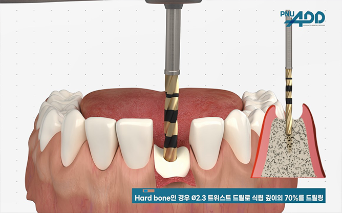 (주)피엔유에드 - 미니 임플란트 시스템