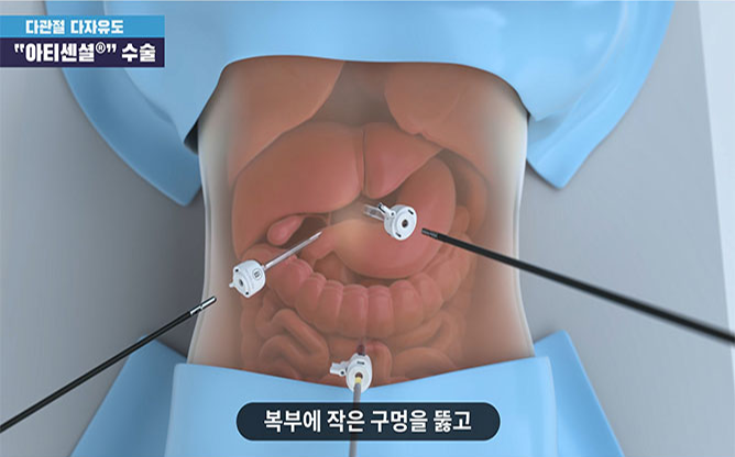 (주)리브스메드 - 복강경 수술기구