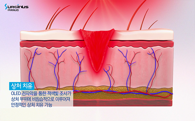 카이스트 - 광치료 패치 전자약