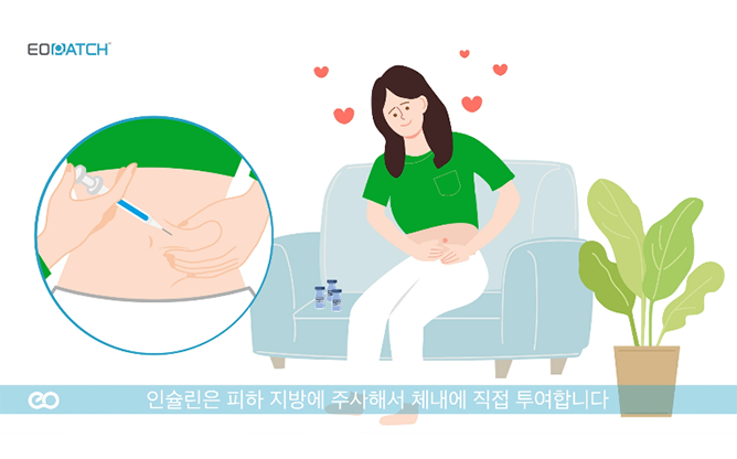 이오플로우 - 체외용 인슐린 주입기