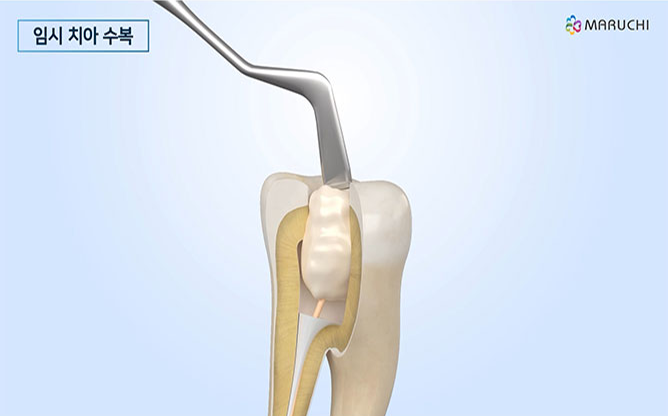 주식회사 마루치 - 최소침습 근관치료 가이드