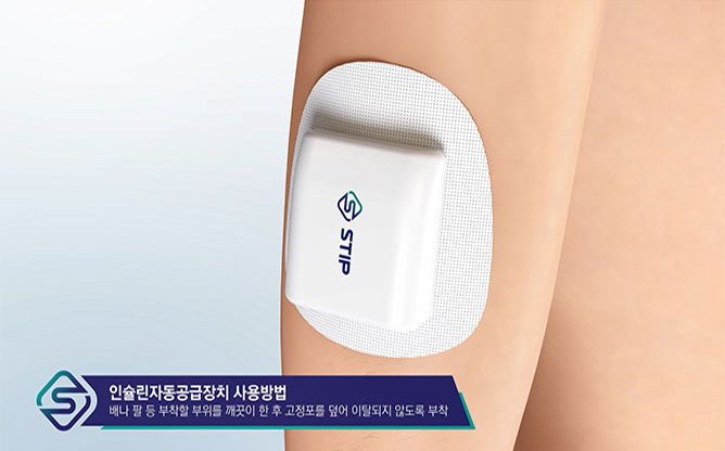 스팁 - 자동 인슐린 주입장치
