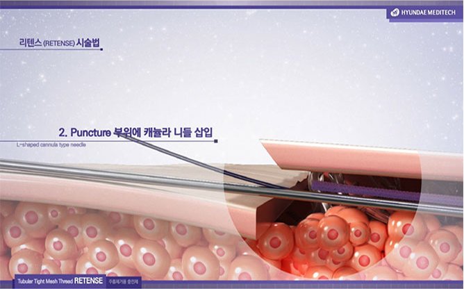 (주)현대메디텍 - 의료기기 개발 전문