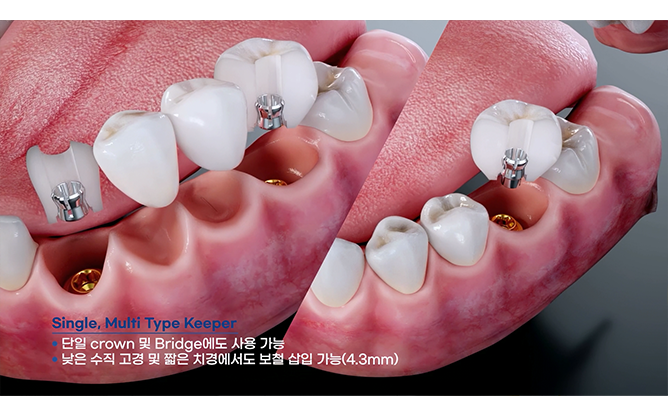 주식회사 이프로스 - 임플란트 구조체