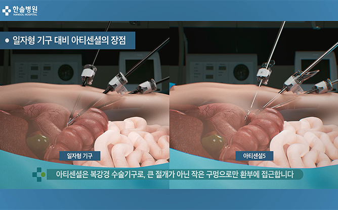리브스메드 - 복강경 수술기구