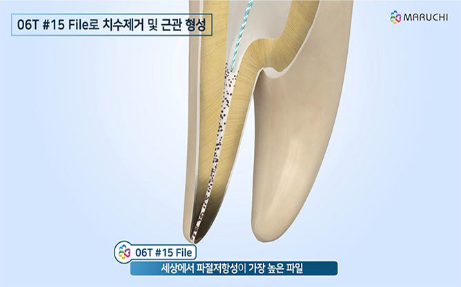 주식회사 마루치 - 최소침습 근관치료 가이드