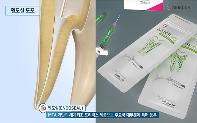 주식회사 마루치 - 최소침습 근관치료 가이드