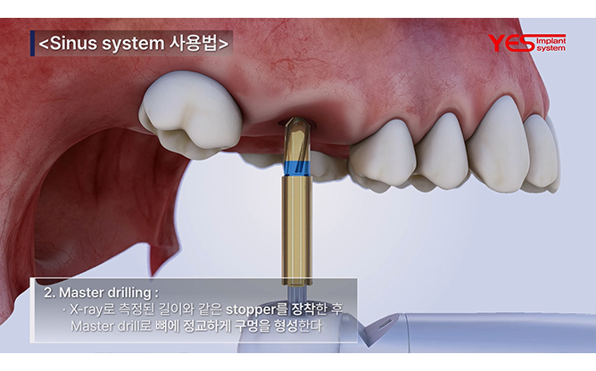예스바이오테크 - 임플란트 시스템