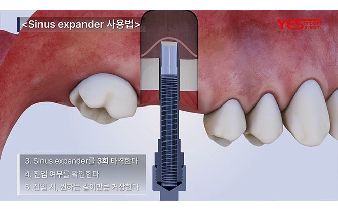 예스바이오테크 - 임플란트 시스템