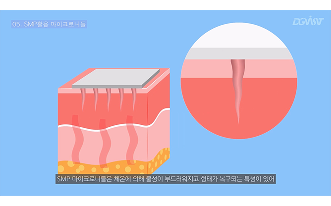 대구경북과학기술원 - 폴리머 기반 마이크로니들 패치