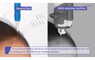 주식회사 오대 - 멀티 모발이식기 INRUT