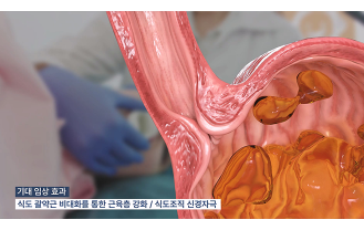(주)티큐어 - 첨단 내시경 치료 솔루션 전문 기업