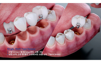 주식회사 이프로스 - 임플란트 구조체
