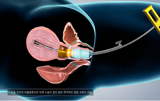 (주)오렌지메딕스 - 자궁거상기