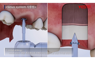 예스바이오테크 - 임플란트 시스템